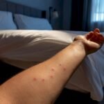 Clustered bed bug bites beside bedroom